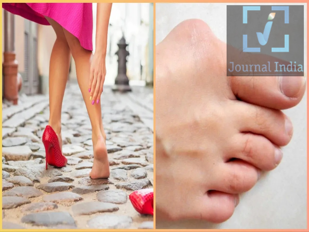 Health Tips- क्या आपकी एड़ियों में कील चुभने जैसा महसूस होता हैं, जानिए किस बीमारी का हैं संकेत दोस्तो जब आप सुबह उठते हैं और जमीन पर पैर रखते ही एड़ी में तेज चुभन या सुई जैसी दर्द महसूस होती है, तो इसे केवल थकान समझकर नजरअंदाज नहीं करना चाहिए। यह समस्या बार-बार हो और कुछ कदम चलने के बाद दर्द कम हो जाए, लेकिन लंबे समय तक खड़े रहने या ज्यादा चलने पर फिर बढ़ जाए, तो यह Plantar Fasciitis (प्लांटर फैसिआइटिस) से जुड़ा हो सकता है। आइए जानते हैं इसके बारे में- Plantar Fasciitis क्या है? Plantar Fascia एक मजबूत ऊतक होता है, जो एड़ी की हड्डी से लेकर पैर की उंगलियों तक फैला रहता है। यह पैर के आर्च को सहारा देने के साथ-साथ चलते और दौड़ते समय लगने वाले झटकों को संभालने में मदद करता है। जब इस ऊतक पर लगातार या जरूरत से ज्यादा दबाव पड़ता है, तो उसमें छोटे-छोटे नुकसान और जलन हो सकती है। इसका असर खासतौर पर एड़ी के आसपास दर्द के रूप में दिखाई देता है। सुबह का पहला कदम इतना दर्दनाक क्यों होता है? इस समस्या का सबसे आम संकेत है सुबह उठने के बाद पहले कुछ कदमों में तेज दर्द। रातभर आराम के दौरान पैर का प्रभावित ऊतक स्थिर रहता है। सुबह अचानक पैर पर वजन पड़ने और ऊतक के खिंचने से एड़ी में तेज चुभन महसूस हो सकती है। कई लोगों में कुछ देर चलने के बाद दर्द कम हो जाता है। हालांकि, लंबे समय तक खड़े रहने, ज्यादा पैदल चलने या व्यायाम करने के बाद दर्द दोबारा बढ़ सकता है। किन लोगों में इसका खतरा अधिक हो सकता है? लंबे समय तक खड़े रहकर काम करने वाले लोग। अचानक शारीरिक गतिविधि या व्यायाम बढ़ाने वाले लोग। लगातार दौड़ने या ज्यादा पैदल चलने वाले लोग। शरीर का वजन अधिक होने पर पैरों और एड़ियों पर अतिरिक्त दबाव पड़ सकता है। ऐसे जूते पहनना जिनमें पर्याप्त आराम या सपोर्ट न हो। लंबे समय तक कठोर सतह पर नंगे पैर चलना भी कुछ लोगों में परेशानी बढ़ा सकता है। क्या एड़ी का दर्द डायबिटीज का संकेत भी हो सकता है? लगातार एड़ी या पैर में दर्द को कुछ लोग डायबिटीज से जोड़ते हैं। हालांकि, सिर्फ एड़ी में दर्द होने का मतलब यह नहीं है कि व्यक्ति को डायबिटीज है। इसके कई अन्य कारण भी हो सकते हैं। अगर दर्द लगातार बना हुआ है, बार-बार हो रहा है या इसके साथ पैरों में सुन्नपन, झनझनाहट या अन्य असामान्य लक्षण दिखाई देते हैं, तो डॉक्टर से जांच और उचित सलाह लेना बेहतर है। दर्द से राहत के लिए क्या करें? शुरुआती स्तर पर कुछ सामान्य उपाय मददगार हो सकते हैं: पैर के तलवे और पिंडलियों की हल्की स्ट्रेचिंग करें। जरूरत पड़ने पर ठंडी सिकाई कर सकते हैं। ऐसे जूते पहनें जिनमें आराम और पर्याप्त सपोर्ट हो। लंबे समय तक कठोर फर्श पर नंगे पैर चलने से बचें। अचानक बहुत ज्यादा दौड़ना या व्यायाम शुरू करने के बजाय गतिविधि धीरे-धीरे बढ़ाएं। लंबे समय तक खड़े रहने या चलने के बाद पैरों को पर्याप्त आराम दें।