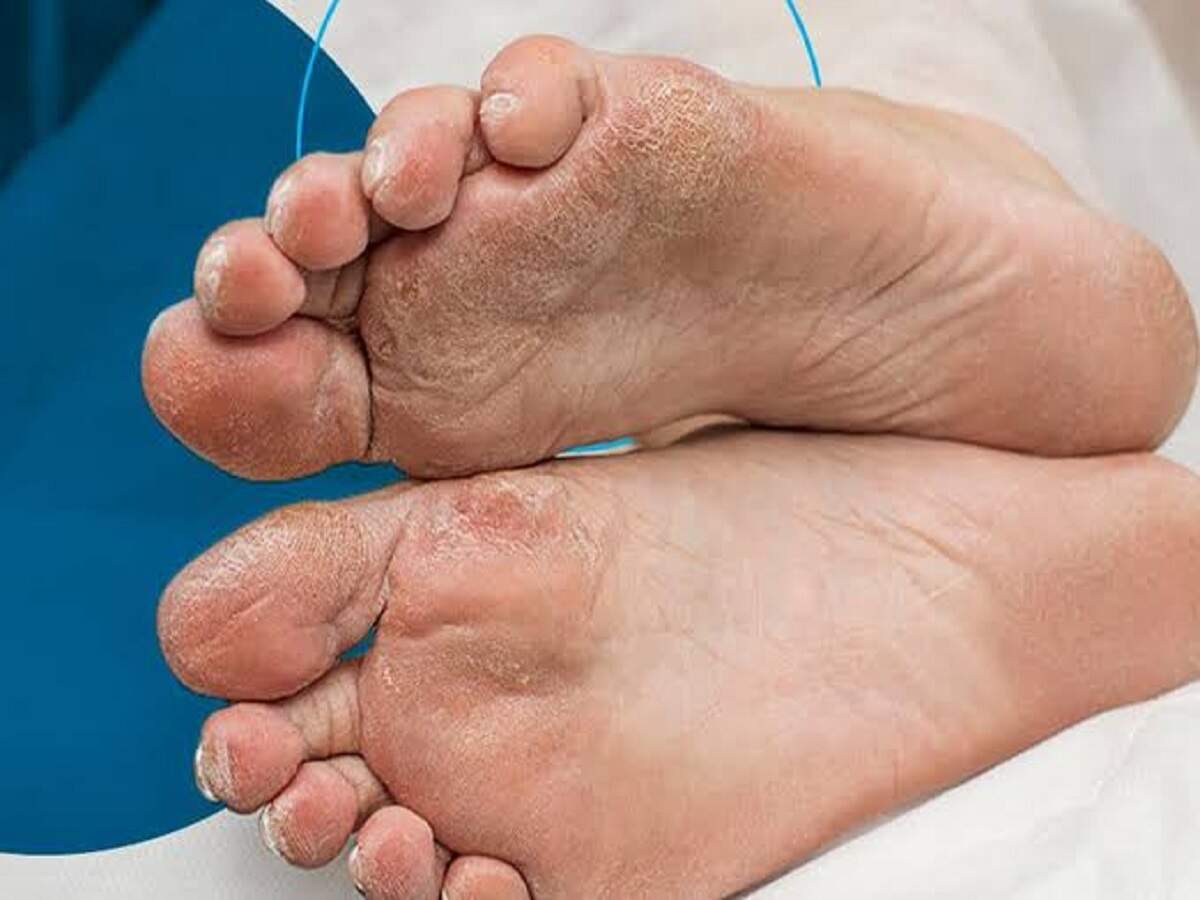 Health Tips: These symptoms appear in the feet when you have diabetes—take special care.