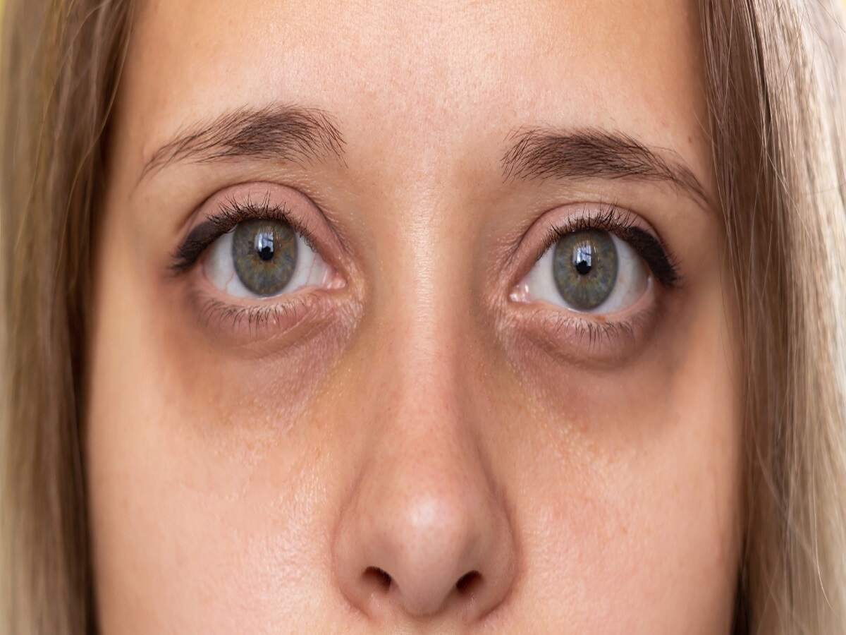 Eye Care Tips &ndash; Do you have dark circles under your eyes? Let&rsquo;s find out the reasons behind them.
