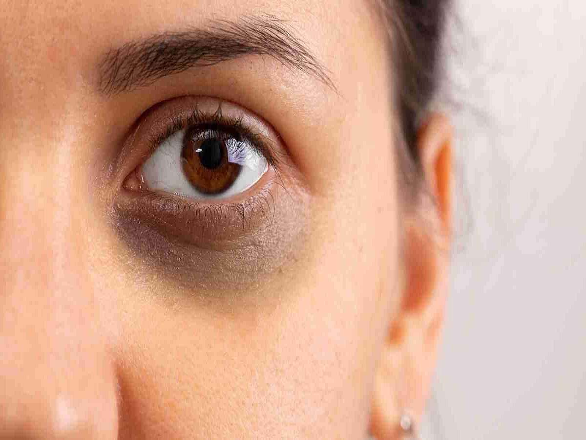 Eye Care Tips – Do you have dark circles under your eyes? Let’s find out the reasons behind them.