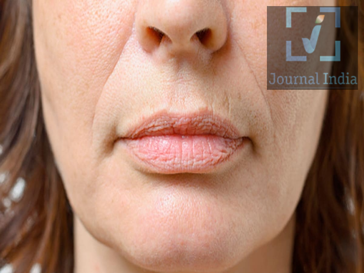 Skin Care Tips- कम उम्र में ही झुर्रियां ने कर रखा हैं परेशान, कम करने के लिए घर पर बनाएं DIY फेस ऑयल दोस्तो आज के युवा कम उम्र में ही रूखापन, बेजान त्वचा और झुर्रियों वाली त्वचा से परेशान हैं, जिनको कम करने के लिए वो रसायन युक्त प्रोडक्ट्स का यूज करते हैं, जो हानिकारक होते हैं, लेकिन सही स्किनकेयर तेलों का इस्तेमाल करके चेहरे की हल्की मालिश करने से त्वचा मुलायम हो सकती है, उसका रूप बेहतर हो सकता है और रूखापन कम हो सकता है।  एक DIY फेशियल ऑयल ब्लेंड (घर पर तैयार होने वाला तेल का मिश्रण) साझा किया है, जिसमें नारियल का तेल, मीठे बादाम का तेल और लौंग का तेल शामिल है। जहां नारियल और बादाम का तेल त्वचा की नमी बनाए रखने में मदद कर सकते हैं, वहीं लौंग का तेल गलत तरीके से इस्तेमाल करने पर जलन और एलर्जी पैदा कर सकता है। इसलिए, घर पर तैयार किए गए किसी भी स्किनकेयर उपाय को आजमाने से पहले उसके फायदों और जोखिमों को समझना जरूरी है। 1. DIY फेशियल ऑयल के लिए सामग्री आपकी त्वचा के प्रकार के आधार पर, चेहरे की मालिश के लिए निम्नलिखित सामग्रियों का इस्तेमाल किया जा सकता है: - नारियल का तेल: यह त्वचा को मुलायम बनाने और नमी को कम होने से रोकने में मदद करता है। कुछ लोगों में यह रोमछिद्रों (pores) को बंद कर सकता है और मुहांसों (breakouts) का कारण बन सकता है। - मीठे बादाम का तेल: यह रूखी त्वचा को नमी देने और उसे मुलायम बनाने में मदद कर सकता है। - लौंग का तेल: यह एक बहुत ही सांद्र (concentrated) एसेंशियल ऑयल है, जिससे त्वचा में जलन हो सकती है। इसे सीधे चेहरे पर लगाने से बचें और किसी विशेषज्ञ की सलाह के बिना इसे घर पर बनाए गए मिश्रण में न मिलाएं। 2. घर पर चेहरे की मालिश कैसे करें 1. चेहरा साफ करें: अपने चेहरे को एक माइल्ड (हल्के) क्लींजर से धो लें। 2. थोड़ा सा तेल लगाएं: अपनी साफ हथेलियों पर कुछ बूंदें सही फेशियल ऑयल की लें। 3. हल्के हाथों से मालिश करें: त्वचा को खींचे बिना, हल्के हाथों से ऊपर और बाहर की दिशा में मालिश करें। 4. आंखों के आसपास का ध्यान रखें: ध्यान रखें कि तेल आपकी आंखों में न जाए और आंखों के आसपास बहुत ज्यादा दबाव न डालें। 5. जलन होने पर रुक जाएं: अगर आपको जलन, लालिमा, खुजली या कोई असहजता महसूस हो, तो तुरंत चेहरे से उस उत्पाद को धो लें। जिन लोगों की त्वचा तैलीय (oily) है या जिन पर आसानी से मुहांसे (acne) हो जाते हैं, उन्हें नारियल का तेल इस्तेमाल करते समय सावधानी बरतनी चाहिए, क्योंकि इससे मुहांसे और बढ़ सकते हैं।  3. फेस ऑयल का इस्तेमाल करने से पहले जरूरी सावधानियां - पैच टेस्ट करें: किसी भी नए प्रोडक्ट को पहले त्वचा के एक छोटे हिस्से पर लगाकर देखें। अगर लालिमा, खुजली या जलन महसूस हो, तो इसका इस्तेमाल बंद कर दें। - लौंग के तेल (क्लोव ऑयल) को सीधे लगाने से बचें: इसमें मौजूद सक्रिय तत्व बहुत तेज हो सकते हैं, जिससे चेहरे की संवेदनशील त्वचा में जलन हो सकती है। - सही मॉइस्चराइजर चुनें: फेस ऑयल त्वचा को मुलायम बनाने में मदद कर सकते हैं, लेकिन ये हमेशा एक अच्छे मॉइस्चराइजर जितना हाइड्रेशन नहीं दे पाते। - रोज सनस्क्रीन लगाएं: UV किरणों से होने वाले नुकसान और समय से पहले त्वचा के बूढ़े होने (एजिंग) से बचने के लिए, SPF 30 या उससे ज्यादा वाला ब्रॉड-स्पेक्ट्रम सनस्क्रीन इस्तेमाल करें। - विशेषज्ञ की सलाह लें: अगर आपको लगातार मुहांसे, संवेदनशील त्वचा या बार-बार जलन की समस्या होती है, तो त्वचा विशेषज्ञ (डर्मेटोलॉजिस्ट) से सलाह लें। 4. क्या घर पर बनाए गए (DIY) फेस ऑयल झुर्रियों को दूर कर सकते हैं? नारियल का तेल और मीठे बादाम का तेल त्वचा में नमी बनाए रखकर रूखी त्वचा को बेहतर दिखा सकते हैं। इससे रूखेपन के कारण दिखने वाली बारीक रेखाएं (फाइन लाइन्स) कुछ समय के लिए कम नजर आ सकती हैं। इस बात के पर्याप्त वैज्ञानिक प्रमाण नहीं हैं कि ये तेल झुर्रियों को पूरी तरह खत्म कर सकते हैं या त्वचा की एजिंग को उलट सकते हैं। चेहरे की मालिश आपकी स्किनकेयर रूटीन का हिस्सा हो सकती है। 5. स्वस्थ और चमकदार त्वचा के लिए टिप्स - अपने चेहरे को हल्के हाथों से साफ करें और नियमित रूप से मॉइस्चराइजर लगाएं। - हर दिन ब्रॉड-स्पेक्ट्रम सनस्क्रीन का इस्तेमाल करें। - संतुलित आहार लें और भरपूर नींद लें। - अपनी त्वचा के प्रकार (स्किन टाइप) के अनुसार ही स्किनकेयर प्रोडक्ट्स चुनें। - अगर झुर्रियां, पिगमेंटेशन, मुहांसे या त्वचा से जुड़ी अन्य समस्याएं लगातार बनी रहती हैं, तो त्वचा विशेषज्ञ (डर्मेटोलॉजिस्ट) से सलाह लें।