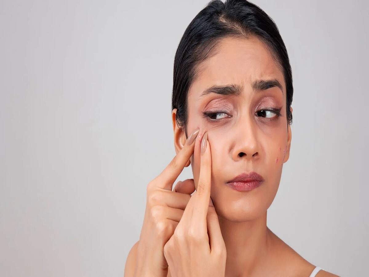 Acne Tips – Your daily mistakes could trigger acne; find out what they are.