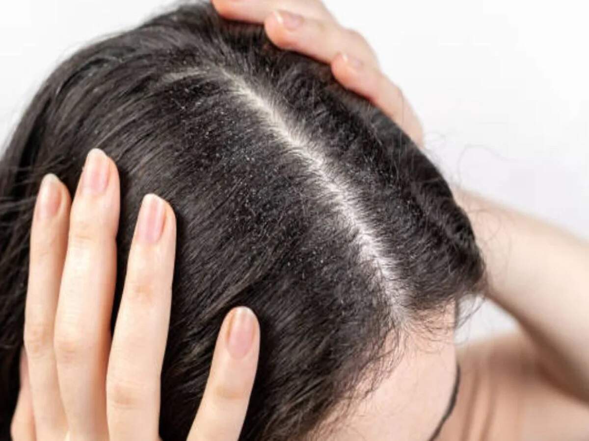 Hair Care Tips – Troubled by recurring dandruff? Find out the causes.