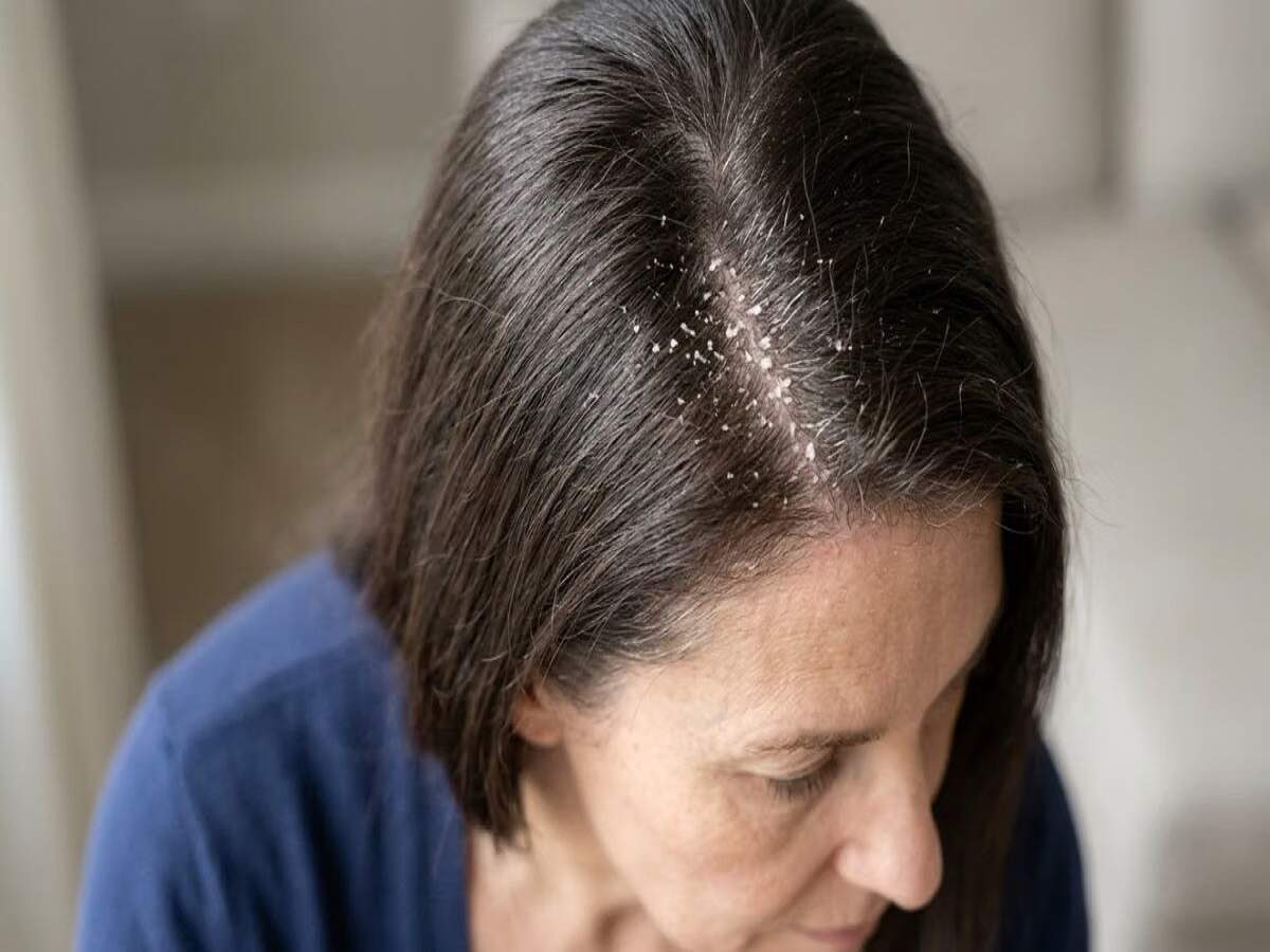 Hair Care Tips – Troubled by recurring dandruff? Find out the causes.