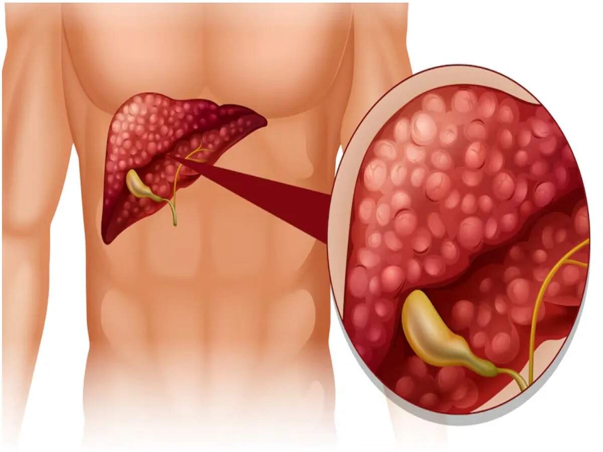 Health Tips- फैटी लिवर क्या बदल सकता हैं कैंसर में, जानिए एक्सपर्ट्स की राय