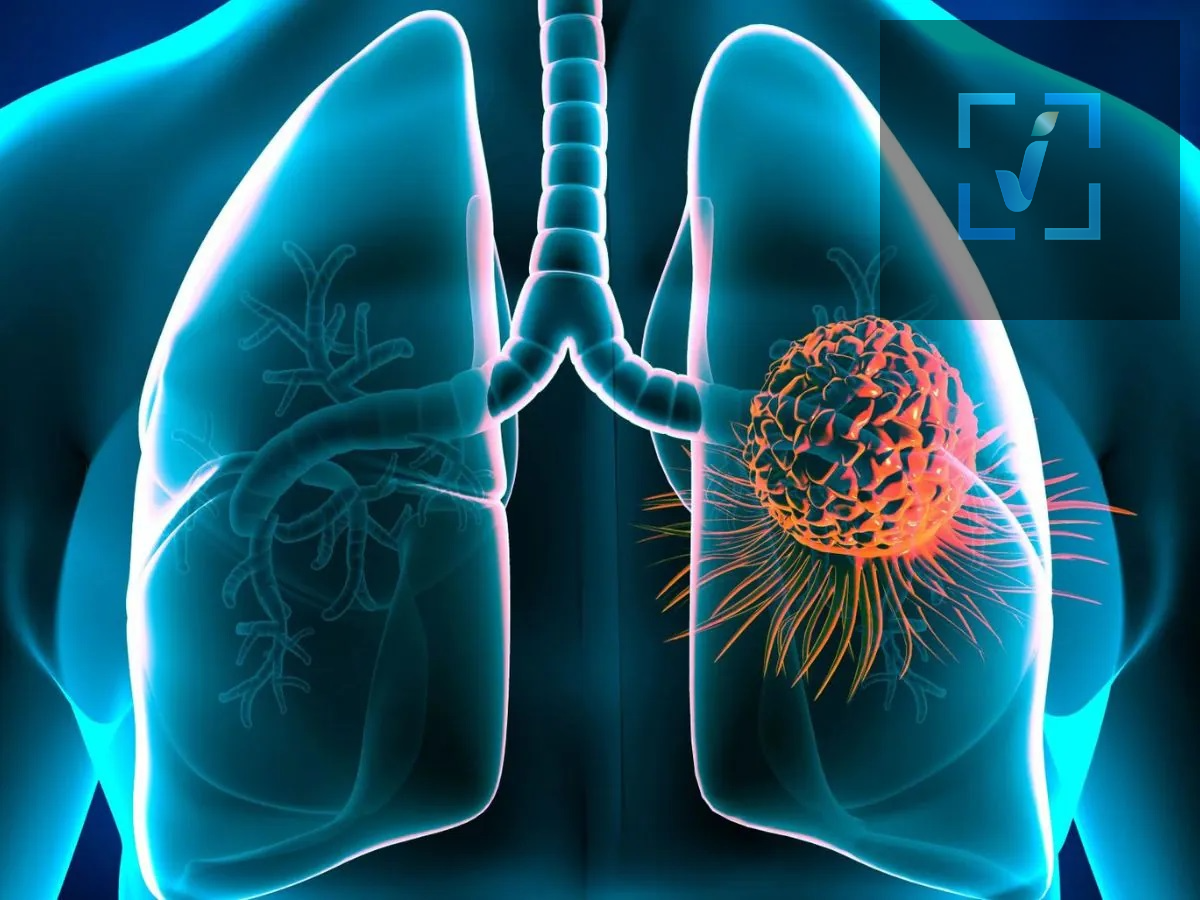Health Tips &ndash; These people should definitely undergo lung cancer screening; find out why.