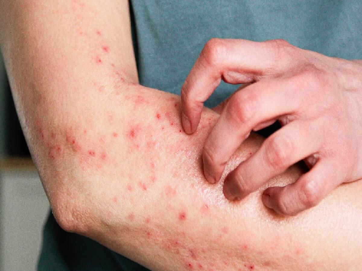 Fungal Infection – Mistakes made during the monsoon can lead to fungal infections; find out how.