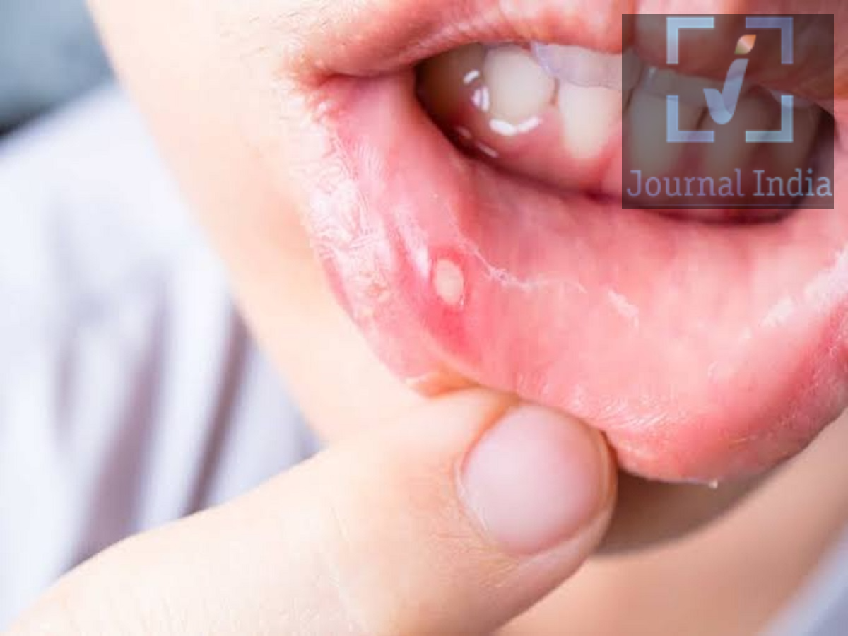 Health Tips: Mouth ulcers can cause ear pain&mdash;find out why.