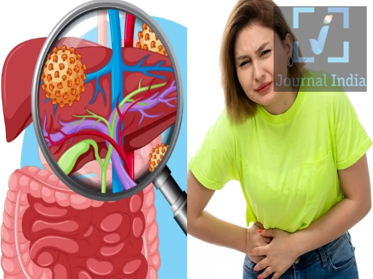 Health Tips- फैटी लिवर क्या बदल सकता हैं कैंसर में, जानिए एक्सपर्ट्स की राय दोस्तो आज के दूषित खान पान की वजह से फैटी लिवर की बीमारी आम होती जा रही हैं, अक्सर पूछे जाने वाले सवालों में से एक यह है कि क्या फैटी लिवर होने से कैंसर हो सकता है। मेडिकल विशेषज्ञों के अनुसार, फैटी लिवर होने से अपने आपको कैंसर नहीं हो जाता, लेकिन इस बीमारी के कुछ रूप समय के साथ लिवर कैंसर होने का खतरा बढ़ा सकते हैं। आइए जानते हैं इसके बारे में विस्तार से-  1. फैटी लिवर की बीमारी क्या है? फैटी लिवर की बीमारी तब होती है जब लिवर में बहुत अधिक फैट (वसा) जमा हो जाता है। इसके कोई स्पष्ट लक्षण दिखाई नहीं दे सकते हैं। हालांकि, अगर फैट जमा होने के साथ-साथ सूजन (इन्फ्लेमेशन) भी हो और लिवर को लगातार नुकसान पहुंचता रहे, तो यह बीमारी आगे बढ़ सकती है और लिवर में स्कारिंग (निशान या घाव) का कारण बन सकती है। फैटी लिवर को अक्सर इसमें जमा फैट की मात्रा के आधार पर ग्रेड 1, ग्रेड 2 या ग्रेड 3 के रूप में वर्गीकृत किया जाता है। कुछ मरीजों में, यह स्थिति आगे बढ़कर फाइब्रोसिस और अंततः सिरोसिस का रूप ले सकती है, जिसमें लिवर पर गंभीर निशान (स्कारिंग) बन जाते हैं। 2. क्या फैटी लिवर से कैंसर हो सकता है? फैटी लिवर की बीमारी लिवर कैंसर के बढ़ते खतरे से जुड़ी हो सकती है। इसमें विशेष रूप से 'हेपेटोसेलुलर कार्सिनोमा' (hepatocellular carcinoma) का खतरा होता है, जो प्राइमरी लिवर कैंसर का सबसे आम प्रकार है। फैटी लिवर वाले हर व्यक्ति को कैंसर नहीं होता है। कैंसर का खतरा आमतौर पर तब अधिक होता है जब बीमारी आगे बढ़कर एडवांस्ड फाइब्रोसिस या सिरोसिस के चरण में पहुंच जाती है। कुछ मामलों में, बिना सिरोसिस के भी लिवर कैंसर हो सकता है। 3. सूजन (इन्फ्लेमेशन) से खतरा कैसे बढ़ता है? जब फैट जमा होने के कारण लगातार सूजन बनी रहती है और लिवर की कोशिकाओं को नुकसान पहुंचता है, तो यह स्थिति 'मेटाबोलिक डिस्फंक्शन-एसोसिएटेड स्टीटोहेपेटाइटिस' (MASH) में बदल सकती है। समय के साथ, लगातार नुकसान होने से फाइब्रोसिस और सिरोसिस हो सकता है, जिससे लिवर कैंसर का खतरा बढ़ जाता है। बीमारी को और अधिक गंभीर चरणों में जाने से रोकने के लिए, समय रहते इसका पता लगाना और सही मेडिकल देखभाल लेना बहुत जरूरी है। 4. फाइब्रोसिस, सिरोसिस और कैंसर के बीच क्या संबंध है? फाइब्रोसिस तब होता है जब लिवर को बार-बार नुकसान पहुंचने के कारण वहां स्कार टिश्यू (निशान वाले ऊतक) बन जाते हैं। अगर ये निशान बहुत ज्यादा फैल जाएं, तो यह स्थिति सिरोसिस में बदल सकती है, जिससे लिवर का सामान्य कामकाज प्रभावित होता है। जिन लोगों को सिरोसिस होता है, उनमें लिवर कैंसर होने का खतरा काफी अधिक बढ़ जाता है। हालाँकि, जोखिम इस बात पर निर्भर करता है कि इसका मूल कारण क्या है, लिवर को कितना नुकसान पहुँचा है, और व्यक्ति की अन्य स्वास्थ्य स्थितियाँ कैसी हैं।
