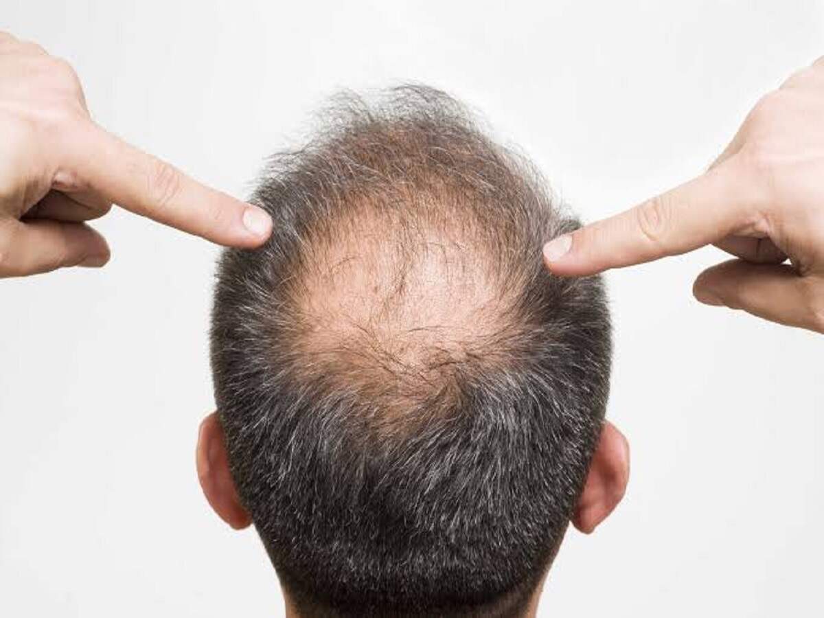 Hair Care Tips: Wearing a dirty helmet can cause scalp allergies—find out what experts say.