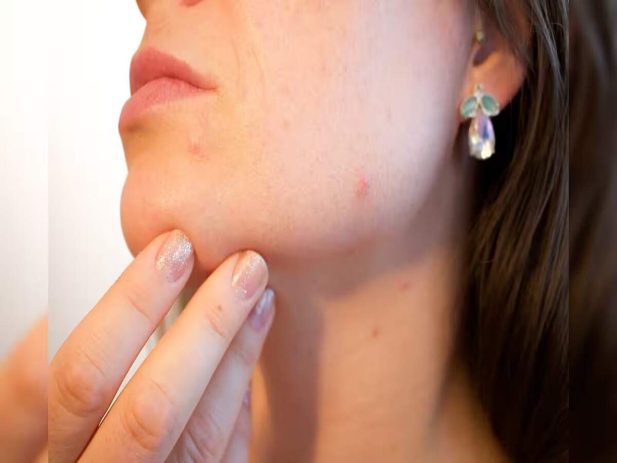 Acne Tips – Your daily mistakes could trigger acne; find out what they are.