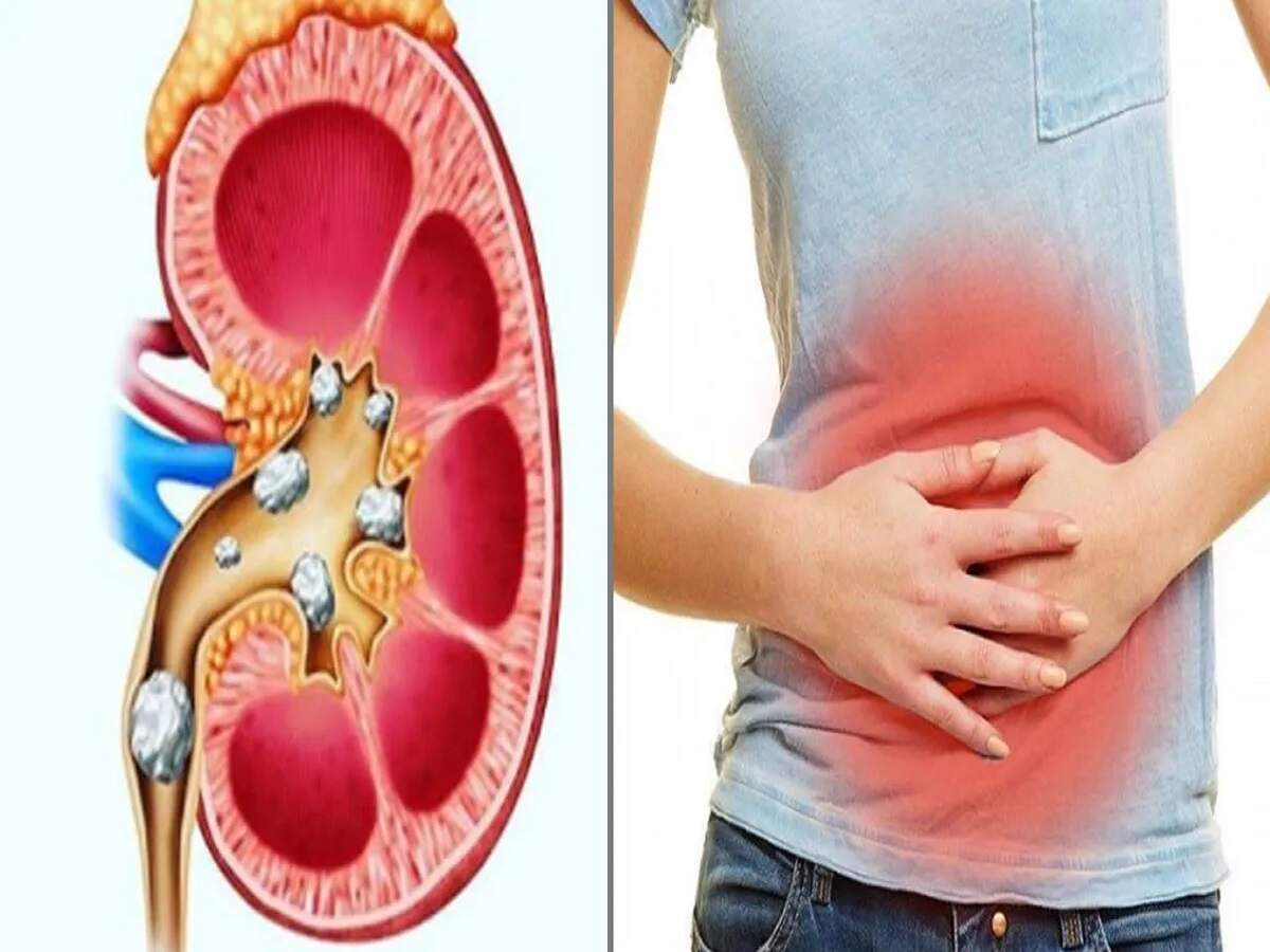 Health Tips- किडनी स्टोन या यूरिन इन्फेक्शन दोनों के लक्षणों को कैसे पहचाने, आइए जानें