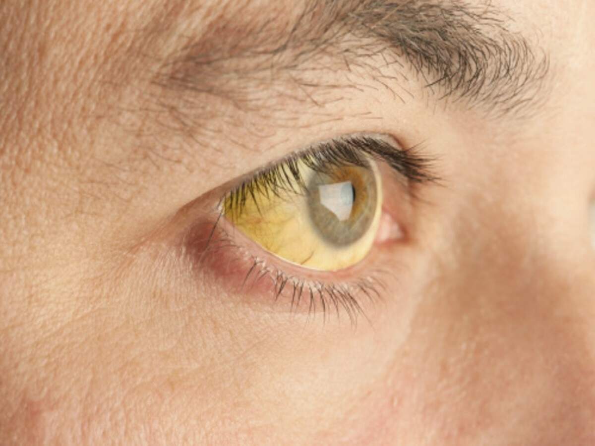 Eye Discharge: क्या आपकी आंखों में सुबह सुबर गंदगी जमा हो जाती हैं, इस बीमारी का हैं खतरा