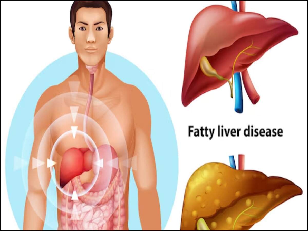 Health Tips: You can treat fatty liver without medication—let's find out how.