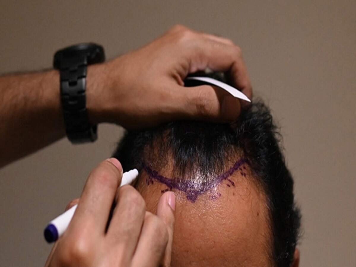 Hair Transplant: Myths that people believe in blindly