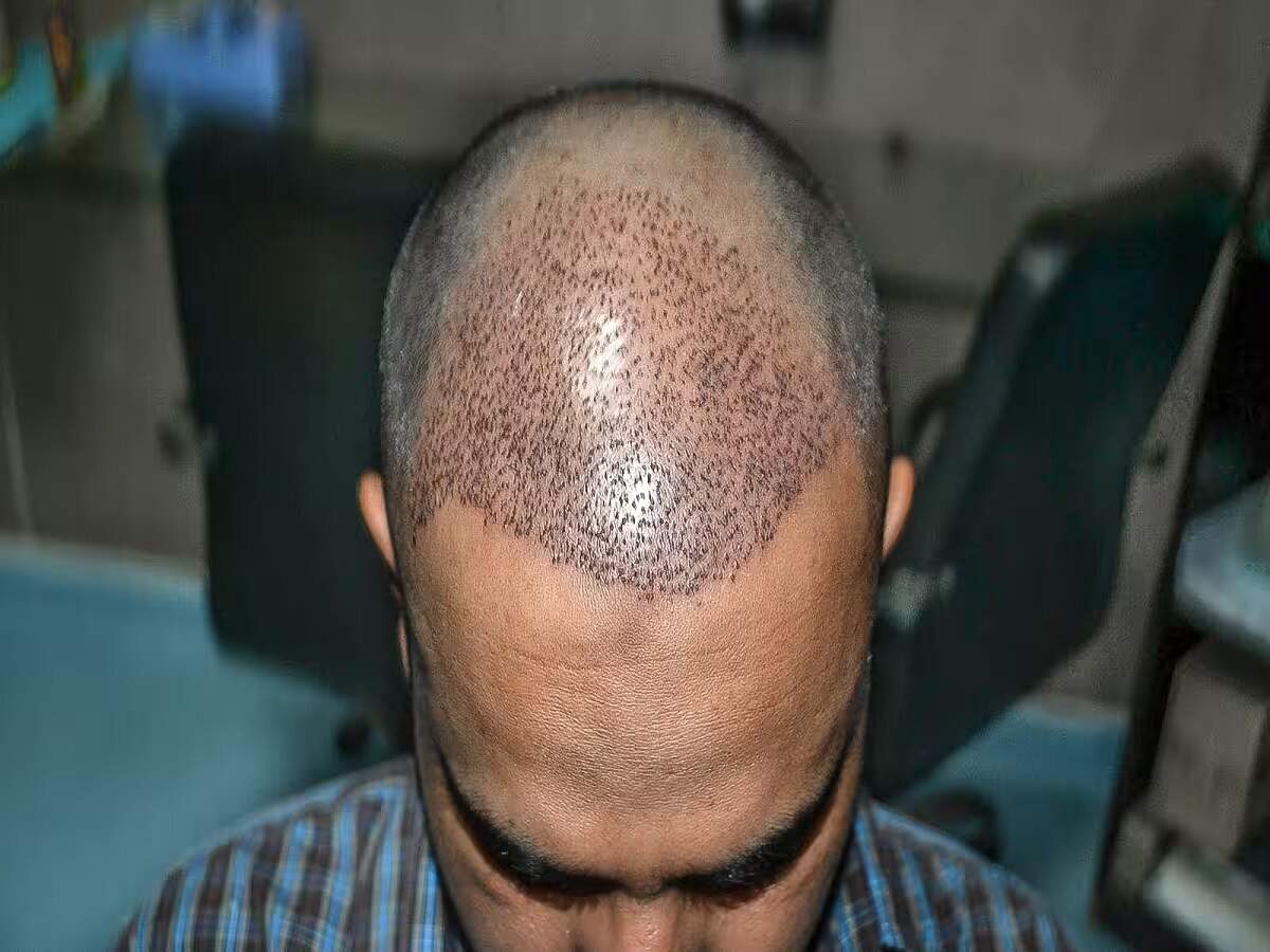 Hair Transplant: Myths that people believe in blindly