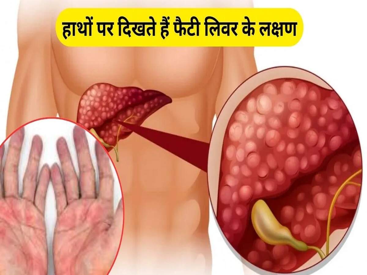 Health Tips: These early symptoms appear with a fatty liver; ignoring them can be life-threatening.