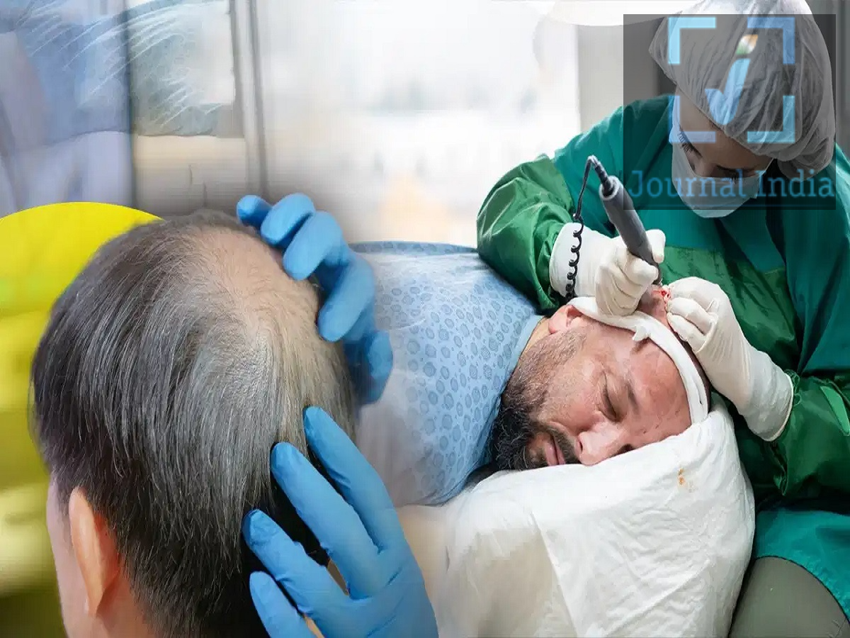 Hair Transplant- हेयर ट्रांसप्लांट के ऐसे मिथक, लोग आंख बंद करके करते हैं विश्वास दोस्तो शरीर के अन्य अंगों की तरह ही हमारे बाल भी बहुत जरूरी हैं, लेकिन कम उम्र में ही बालों का झड़ना आम बात हो गई हैं, जिसके पीछे तनाव, प्रदूषण, बदलती जीवनशैली और जेनेटिक्स जैसे कई कारण हैं। नतीजतन, लोग अपने बालों और आत्मविश्वास को वापस पाने के लिए हेयर ट्रांसप्लांट का सहारा ले रहे हैं। लेकिन हेयर ट्रांसप्लांट को लेकर लोगों में कई गलतफहमी हैं, आइए जानते हैं इनके बारे में-  1. क्या हेयर ट्रांसप्लांट के बाद बाल फिर से झड़ सकते हैं? सबसे आम गलतफहमी यह है कि ट्रांसप्लांट के बाद बाल कभी नहीं झड़ेंगे। ट्रांसप्लांट किए गए बाल आमतौर पर लंबे समय तक टिके रहते हैं, लेकिन उनके आसपास के प्राकृतिक बाल जेनेटिक्स, उम्र बढ़ने या हार्मोनल बदलावों के कारण पतले हो सकते हैं या झड़ सकते हैं। 2. क्या हेयर ट्रांसप्लांट एक दर्दनाक प्रक्रिया है? कई लोग दर्द के डर से हेयर ट्रांसप्लांट कराने से बचते हैं। आजकल की आधुनिक तकनीकें, जैसे फॉलिक्युलर यूनिट एक्सट्रैक्शन (FUE) और डायरेक्ट हेयर इम्प्लांटेशन (DHI), आमतौर पर लोकल एनेस्थीसिया देकर की जाती हैं। इससे प्रक्रिया के दौरान होने वाली तकलीफ काफी कम हो जाती है।बाद में हल्की सूजन, दर्द या बेचैनी हो सकती है, लेकिन ये समस्याएँ आमतौर पर कुछ ही दिनों में ठीक हो जाती हैं।  3. क्या ट्रांसप्लांट के तुरंत बाद घने बाल आ जाते हैं? हेयर ट्रांसप्लांट के परिणाम तुरंत नहीं मिलते। प्रक्रिया के शुरुआती हफ्तों में ट्रांसप्लांट किए गए बालों का झड़ना सामान्य है; इस चरण को 'शॉक लॉस' (shock loss) कहा जाता है। - शुरुआती कुछ हफ्ते: ट्रांसप्लांट किए गए बाल अस्थायी रूप से झड़ सकते हैं। - 3&ndash;4 महीने बाद: नए बाल उगने शुरू हो सकते हैं। - 6&ndash;9 महीने बाद: बालों के घनत्व (density) में स्पष्ट सुधार दिखाई देने लगता है। - 9&ndash;12 महीनों के बाद: परिणाम अधिक स्पष्ट हो जाते हैं, हालाँकि कुछ मरीजों को पूरा परिणाम देखने में अधिक समय लग सकता है। रिकवरी के लिए धैर्य रखना और सर्जन द्वारा दी गई देखभाल संबंधी सलाह (आफ्टरकेयर इंस्ट्रक्शंस) का पालन करना बहुत ज़रूरी है। 4. क्या कोई भी हेयर ट्रांसप्लांट करवा सकता है? हर कोई हेयर ट्रांसप्लांट के लिए उपयुक्त उम्मीदवार नहीं होता है। इस प्रक्रिया के लिए पर्याप्त मात्रा में स्वस्थ 'डोनर बालों' (donor hair) की आवश्यकता होती है, जो आमतौर पर सिर के पिछले हिस्से या किनारों से लिए जाते हैं। जिन लोगों के बाल बहुत तेज़ी से झड़ रहे हैं या जिनके पास डोनर बाल सीमित हैं, उन्हें सर्जरी से पहले मेडिकल इलाज या आगे की जांच की ज़रूरत पड़ सकती है।  5. हेयर ट्रांसप्लांट की सफलता किन बातों पर निर्भर करती है? कई कारक इसके परिणामों को प्रभावित कर सकते हैं, जैसे: - मरीज के सिर की त्वचा (स्कैल्प) का समग्र स्वास्थ्य और बाल झड़ने का पैटर्न। - उपलब्ध डोनर बालों की गुणवत्ता और मात्रा। - सर्जन का अनुभव और इस्तेमाल की गई तकनीक। - बालों के घनत्व (डेंसिटी) और कवरेज के बारे में यथार्थवादी उम्मीदें। - सर्जरी के बाद उचित देखभाल और फॉलो-अप इलाज।