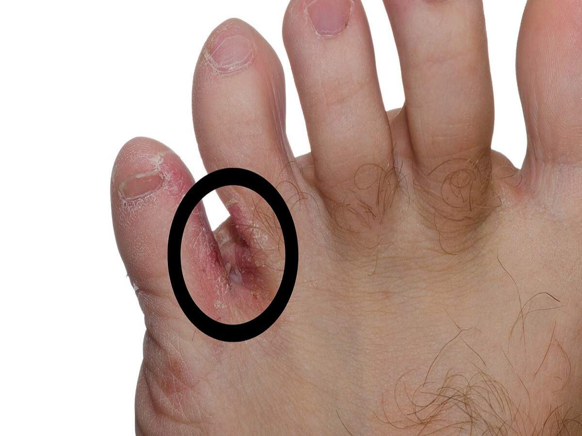 Fungal Infection – Mistakes made during the monsoon can lead to fungal infections; find out how.
