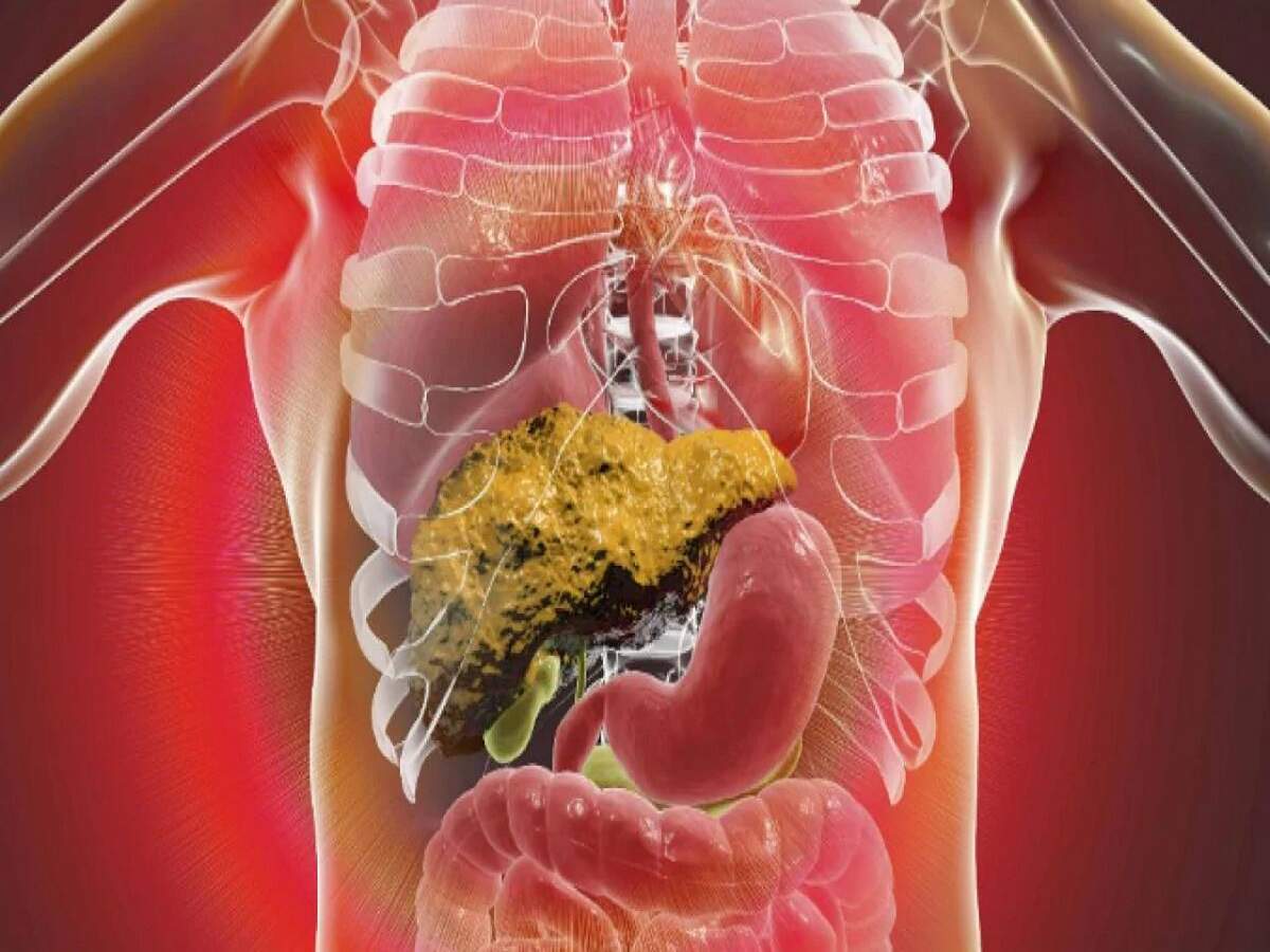 Fatty Liver Symptoms: फैटी लिवर के ये 5 संकेत, पुरुष न करें नजरअंदाज, जानिए इनके बारे में