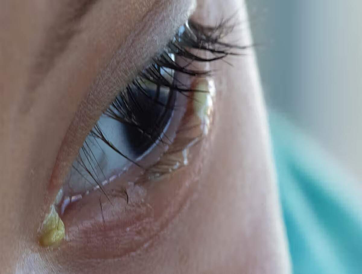 Eye Discharge: Does gunk accumulate in your eyes first thing in the morning? It could indicate a risk of this condition.