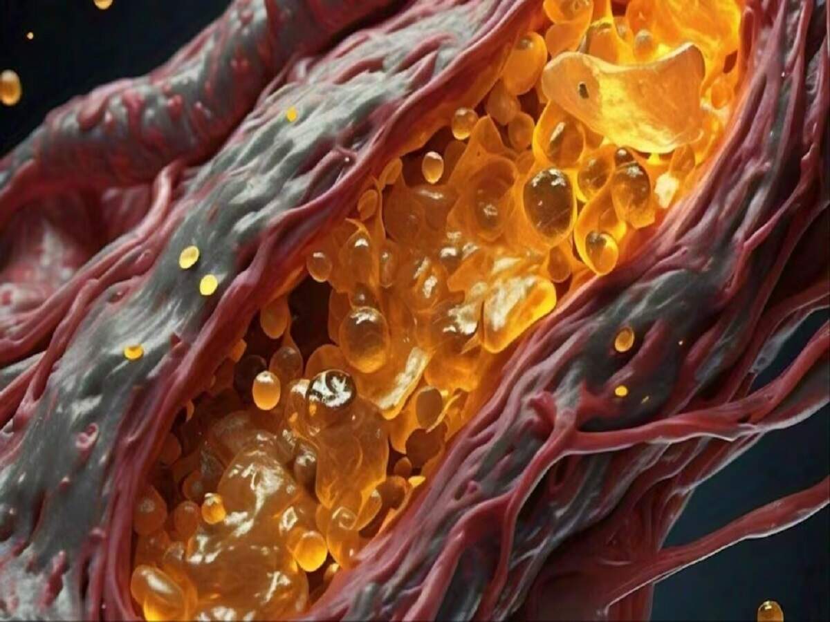 Health Tips: Can cholesterol levels rise even in thin people? Find out the full details.
