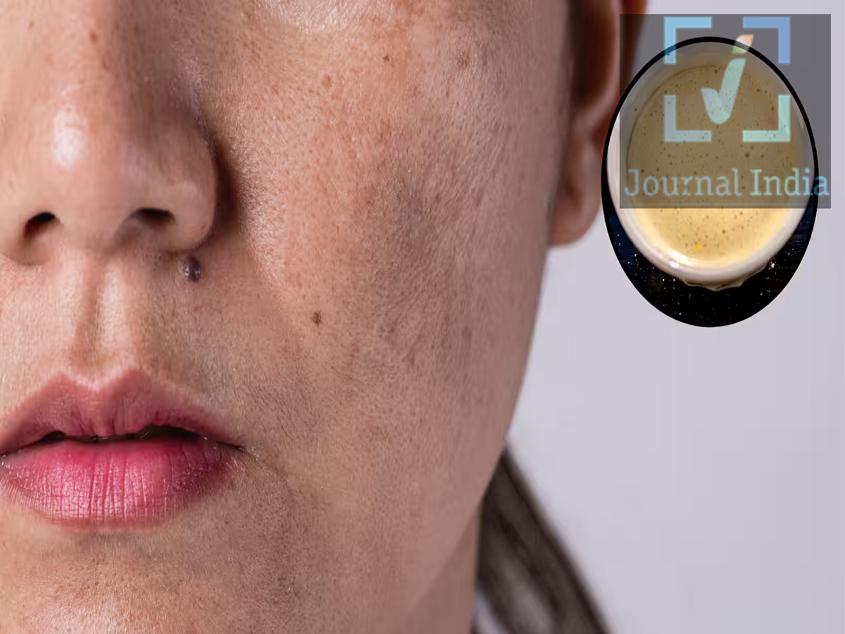Skin Care Tips: उम्र कम हैं फिर भी चेहरे पर झाइयां आ गई, जानिए इन्हें कैसे कम करें दोस्तो दुनिया का हर इंसान खूबसूरत दिखना चाहता हैं, लेकिन वायु प्रदूषण, कैमिकल युक्त प्रोडक्ट्स का यूज कम उम्र में चेहरे पर झाइयां ला देता हैं, पिगमेंटेशन को ठीक करने के लिए सिर्फ क्रीम लगाना काफी नहीं है। धूप से बचाव, स्किनकेयर रूटीन का नियमित पालन और अपनी त्वचा के प्रकार के अनुसार सही प्रोडक्ट्स का चुनाव करना भी उतना ही जरूरी है। आइए जानते हैं पिगमेंटेशन कम करने के तैरीकों के बारे में 1. रोज सनस्क्रीन लगाएं धूप के संपर्क में आने से शरीर में मेलेनिन का उत्पादन बढ़ सकता है, जिससे पहले से मौजूद पिगमेंटेशन और गहरे हो सकते हैं। झाइयों और काले धब्बों को कम करने के लिए रोज 'ब्रॉड-स्पेक्ट्रम SPF 50' सनस्क्रीन लगाना एक बहुत जरूरी कदम है।  घर से बाहर निकलने से पहले अपने चेहरे और गर्दन पर सनस्क्रीन लगाएं। अगर आप बाहर हैं, तो लगभग हर दो घंटे में सनस्क्रीन दोबारा लगाएं। पसीना आने या स्विमिंग करने के बाद इसे और भी जल्दी-जल्दी लगाना चाहिए। तेज धूप में बाहर जाते समय टोपी, छाते या अन्य बचाव के तरीकों का इस्तेमाल करें। ध्यान रखें कि खिड़कियों के जरिए आने वाली धूप भी पिगमेंटेशन का कारण बन सकती है। धूप से लगातार बचाव करने से मौजूदा धब्बों को और गहरा होने से रोका जा सकता है, और धूप की वजह से होने वाले नए पिगमेंटेशन को भी कम किया जा सकता है। 2. बहुत ज्यादा गर्मी से बचें पिगमेंटेशन को बढ़ाने के लिए सिर्फ धूप ही जिम्मेदार नहीं है। कुछ लोगों में, बहुत ज्यादा गर्मी के संपर्क में आने से भी पिगमेंटेशन की समस्या बढ़ सकती है, खासकर 'मेलास्मा' (melasma) के मामले में। 3. सही क्रीम और सीरम चुनें स्किनकेयर में इस्तेमाल होने वाले कुछ खास तत्व त्वचा के असमान रंग (uneven skin tone) को सुधारने और काले धब्बों को कम करने में मदद कर सकते हैं।  इनमें शामिल हैं: कोजिक एसिड (Kojic acid): यह मेलेनिन के उत्पादन को प्रभावित करके पिगमेंटेशन को कम करने में मदद करता है। अल्फा अर्बुटिन (Alpha arbutin): यह कुछ तरह के काले धब्बों को हल्का करने में मददगार हो सकता है। एज़ेलिक एसिड (Azelaic acid): यह पिगमेंटेशन से जुड़ी कुछ समस्याओं और मुहांसों के बाद रह जाने वाले निशानों को सुधार सकता है। ट्रानेक्सैमिक एसिड (Tranexamic acid): इसका इस्तेमाल आमतौर पर मेलास्मा जैसी समस्याओं को ठीक करने के लिए किया जाता है। नियासिनामाइड (Niacinamide): यह स्किन बैरियर को सपोर्ट करता है और अनईवन स्किन टोन (त्वचा के असमान रंग) को बेहतर बनाने में मदद कर सकता है।   4. अपने चेहरे को जोर से न रगड़ें चेहरे को बार-बार रगड़ने से झाइयां (freckles) या पिगमेंटेशन दूर नहीं होते। असल में, ज्यादा रगड़ने से त्वचा में जलन और सूजन हो सकती है, जिससे डार्क स्पॉट्स और भी ज्यादा साफ दिखने लग सकते हैं। एक माइल्ड (हल्के) क्लींजर का इस्तेमाल करें और बहुत तेज असर वाले एक्सफोलिएटिंग प्रोडक्ट्स से बचें। ग्लाइकोलिक एसिड और लैक्टिक एसिड जैसे इंग्रीडिएंट्स त्वचा को एक्सफोलिएट करने में मदद कर सकते हैं, लेकिन इनका इस्तेमाल सावधानी से और अपनी त्वचा की सहनशक्ति के अनुसार ही करना चाहिए।  5. एक रेगुलर स्किनकेयर रूटीन अपनाएं पिगमेंटेशन को ठीक होने में आमतौर पर समय लगता है। बार-बार प्रोडक्ट्स बदलने या बहुत सारे एक्टिव इंग्रीडिएंट्स को एक साथ इस्तेमाल करने से त्वचा में जलन हो सकती है और समस्या और भी बढ़ सकती है। एक आसान डेली रूटीन में ये चीजें शामिल हो सकती हैं: सुबह: माइल्ड क्लींजर मॉइस्चराइजर ब्रॉड-स्पेक्ट्रम SPF 50 सनस्क्रीन रात: माइल्ड क्लींजर मॉइस्चराइजर जरूरत पड़ने पर, पिगमेंटेशन के लिए कोई सही ट्रीटमेंट किसी भी नए प्रोडक्ट को पूरे चेहरे पर लगाने से पहले हमेशा पैच-टेस्ट जरूर करें। तुरंत नतीजों की उम्मीद करने के बजाय, अपने रूटीन को असर दिखाने के लिए पर्याप्त समय दें।