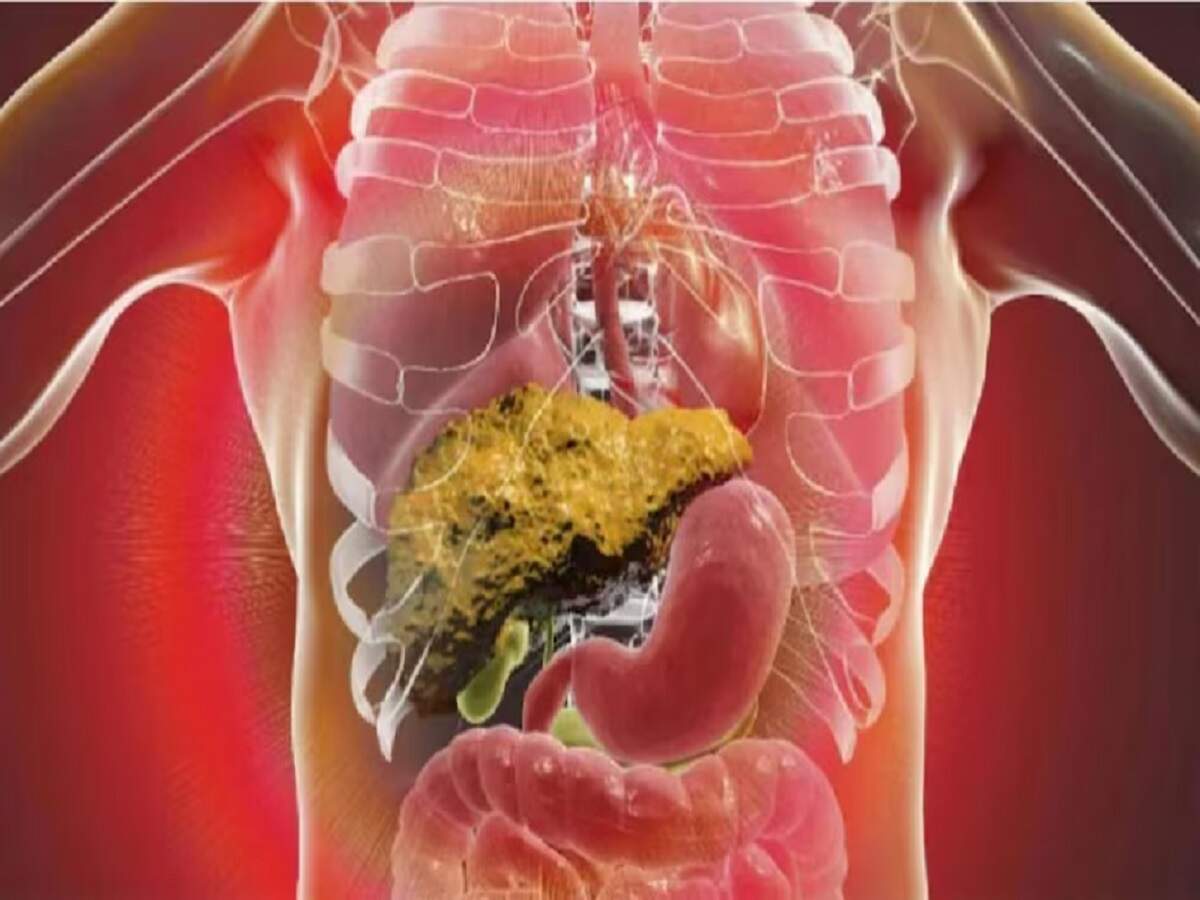 Health Tips: Can thin people develop a fatty liver? Find out the full details.