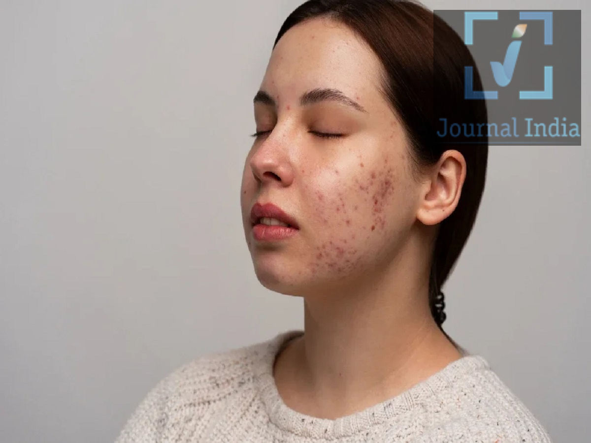 Skincare Tips: Can't tell the difference between fungal acne and regular acne? Here is what the experts say.