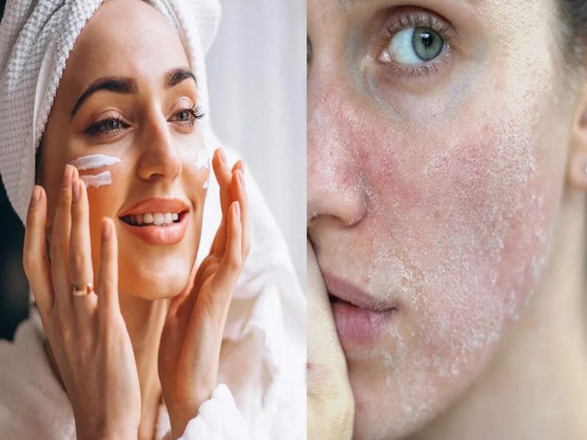 Skincare Tips: Can't tell the difference between fungal acne and regular acne? Here is what the experts say.