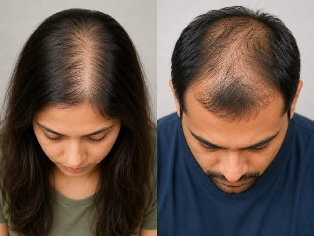 Hair Care Tips: These signs indicate that hair loss has become a medical condition.